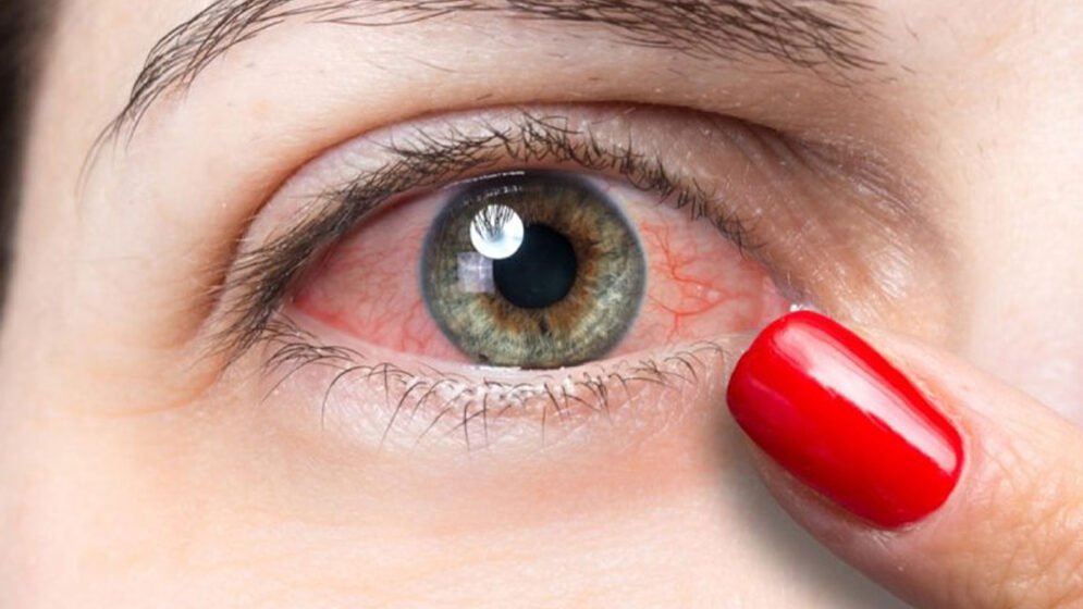 গরমে চোখের যত সমস্যা: সচেতন না হলেই বিপদ